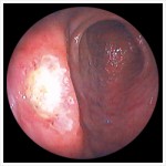 十二指腸潰瘍 - 胃カメラ写真